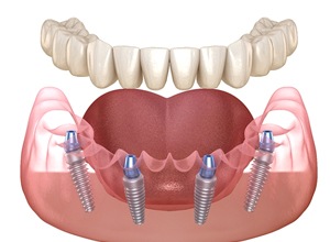 Illustration of All-on-4 dental implants for lower arch