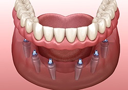 Illustration of full denture for lower arch, supported by six implants