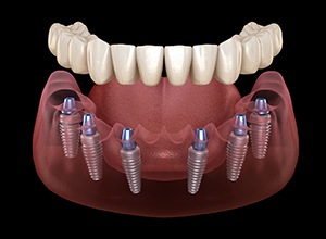 Illustration of implant denture supported by six dental implants