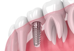 Dental implant with antibacterial coating, integrated with surrounding tissue