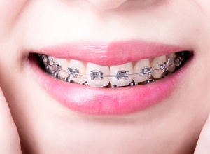 Close-up of woman’s smile with traditional metal braces