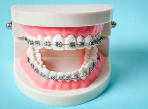 Dental model with braces against light blue background