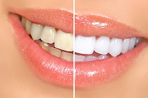 Close-up of woman’s smile before and after teeth whitening