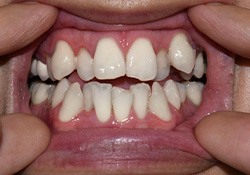 Person pulling their lips back to show crowded, overlapping teeth