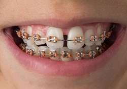 Person with gap between front teeth wearing braces