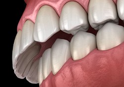 Side-view illustration of an overbite