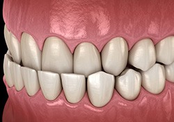Illustration of an underbite