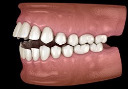 Side view illustration of an open bite