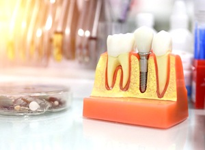 Model of single dental implant and restoration on tabletop