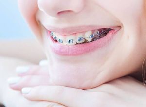 Newington Clear Braces Provider