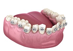 Illustration of braces on crooked lower dental arch