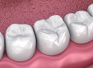 Graphic of tooth colored fillings