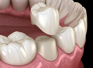 Graphic of dental crown