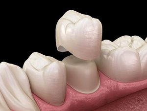 dental crown illustration