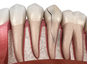 Illustration of broken tooth that might need to be extracted