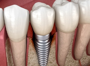Illustration of peri-implantitis, the most common cause of failed dental implants