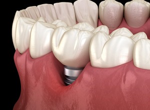 Illustration of gums receding around a dental implant