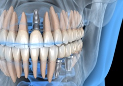 Illustration of three dental implants strategically placed in jawbone