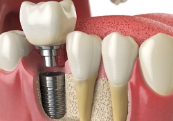 Dental implant, abutment, and crown in lower dental arch