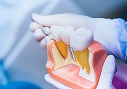 Gloved hands holding dental implant model, explaining guided implant surgery