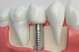 model of dental implants in Newington