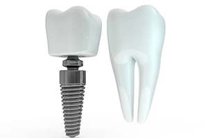 Comparison between a single tooth dental implant in Newington and natural tooth