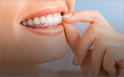 Patient inserting Invisalign tray