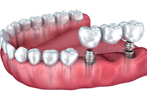 implant-supported bridge