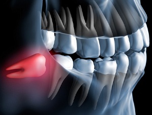 wisdom tooth illustration