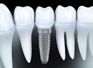 Animation of implant supported dental crown