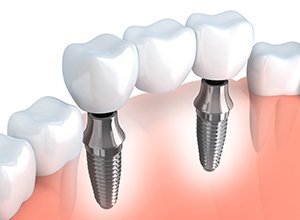 Animation of implant supported fixed bridge