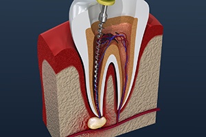 Cross-section of tooth showing its infected interior