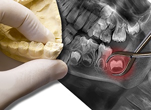 X-rays and model of wisdom teeth to be extracted
