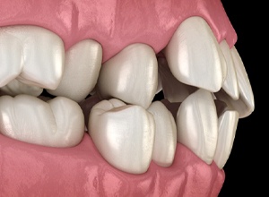 Close-up illustration of misaligned top and bottom teeth
