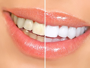 Before and after professional teeth whitening in Newington