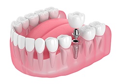 Single dental implant and crown in lower arch