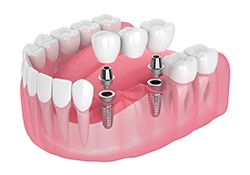 Dental implant bridge to replace three teeth in a row