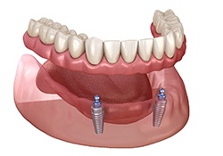 Implant denture supported by two dental implants with ball attachments