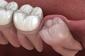 Illustration of impacted wisdom tooth