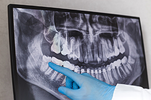 Gloved hand pointing at wisdom tooth on X-ray