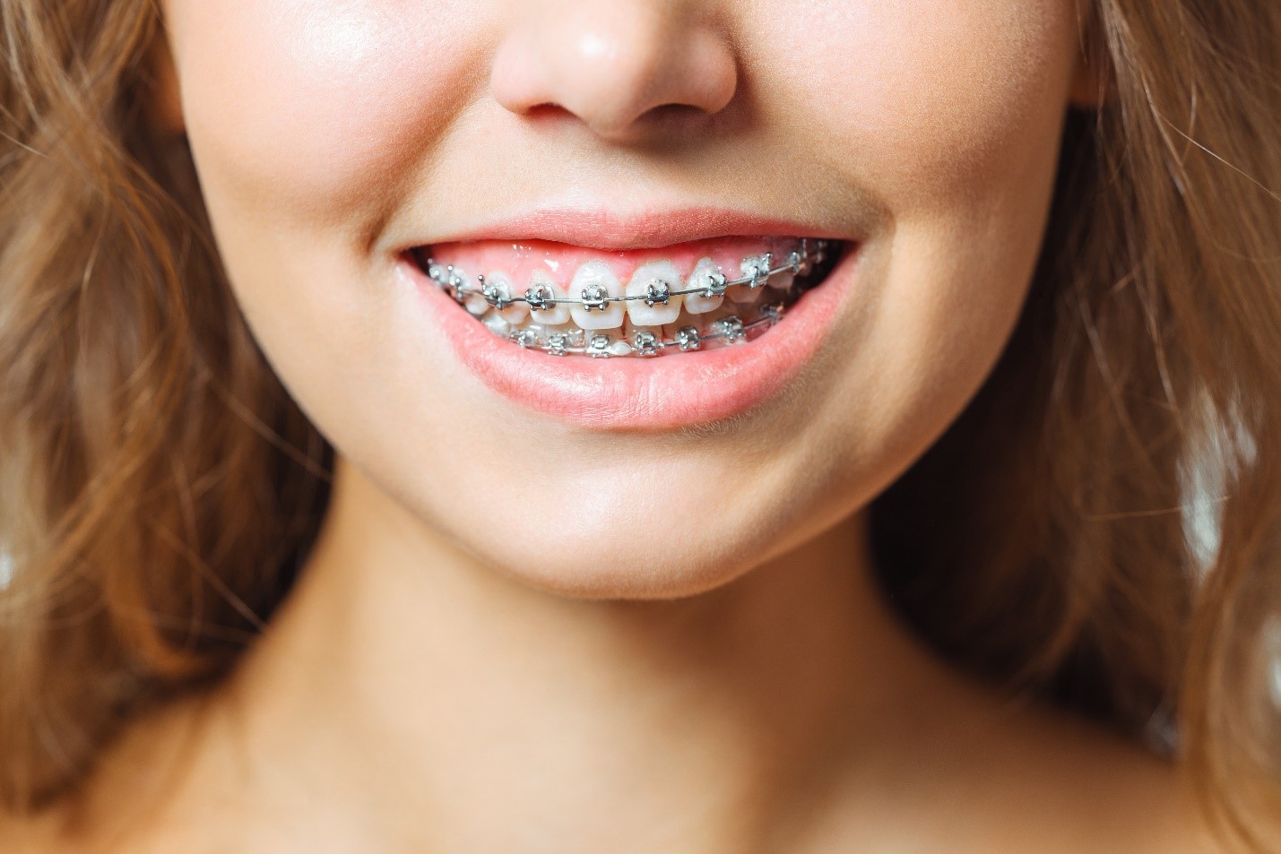 Happy Smile With Braces After Handling Orthodontic Problems At Home 