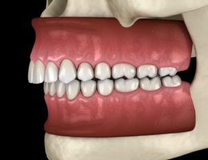 Illustration of overbite, a bite problem that Invisalign can fix