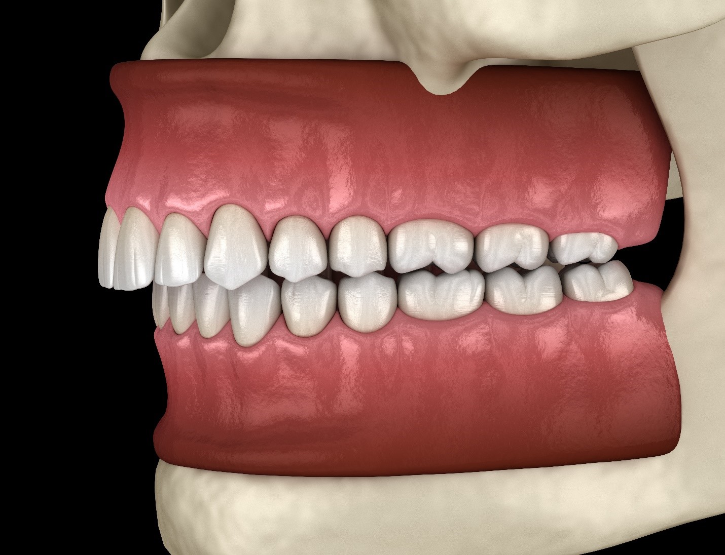 Illustration of overbite a bite problem that Invisalign can