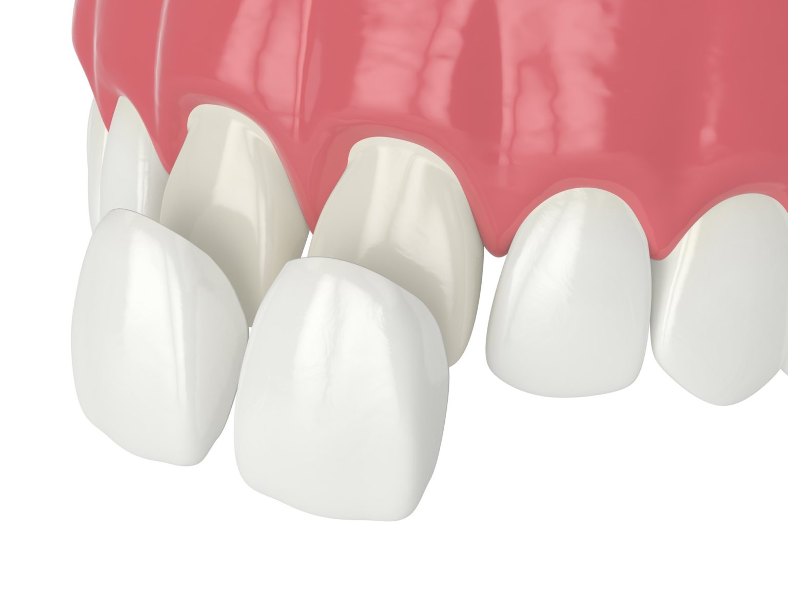 How Much Enamel Needs to Be Removed for Veneers?