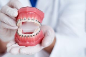 Dental model with traditional braces in Newington on top and bottom teeth